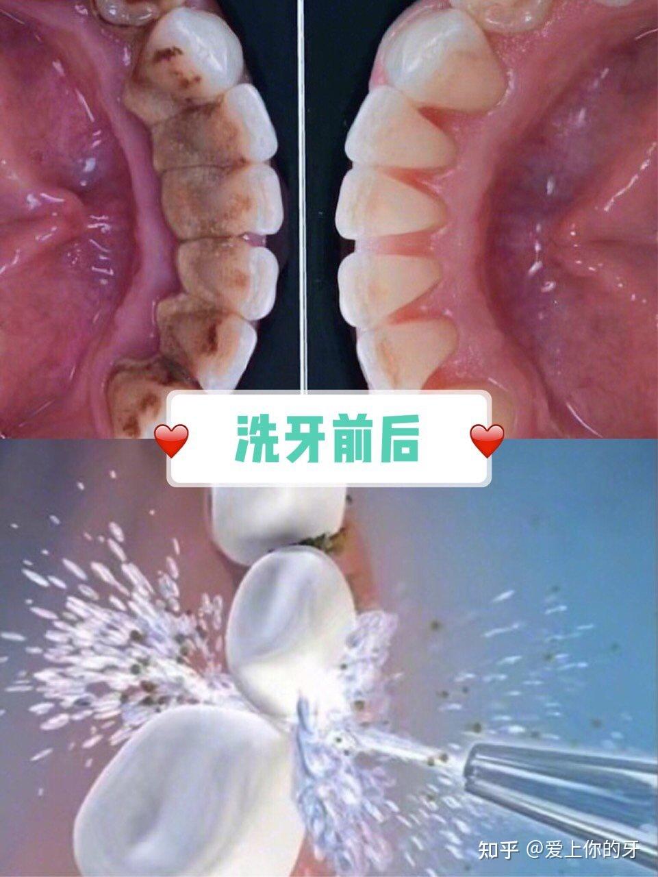 阜新洗牙可以用医保吗(洗牙可以用医保吗,报销比例多少)